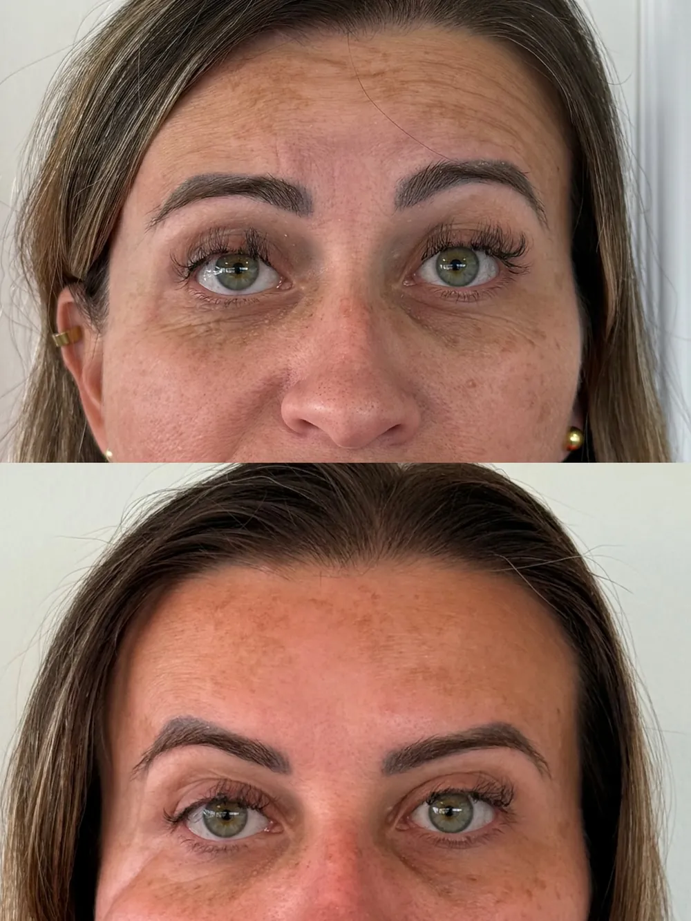 Caso 01: antes e depois de harmonização orofacial, região dos olhos e testa