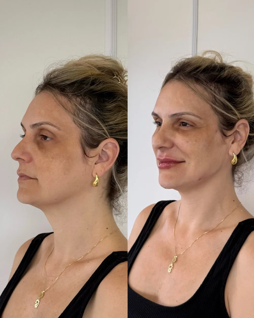 Caso 02: antes e depois de harmonização orofacial, perfil