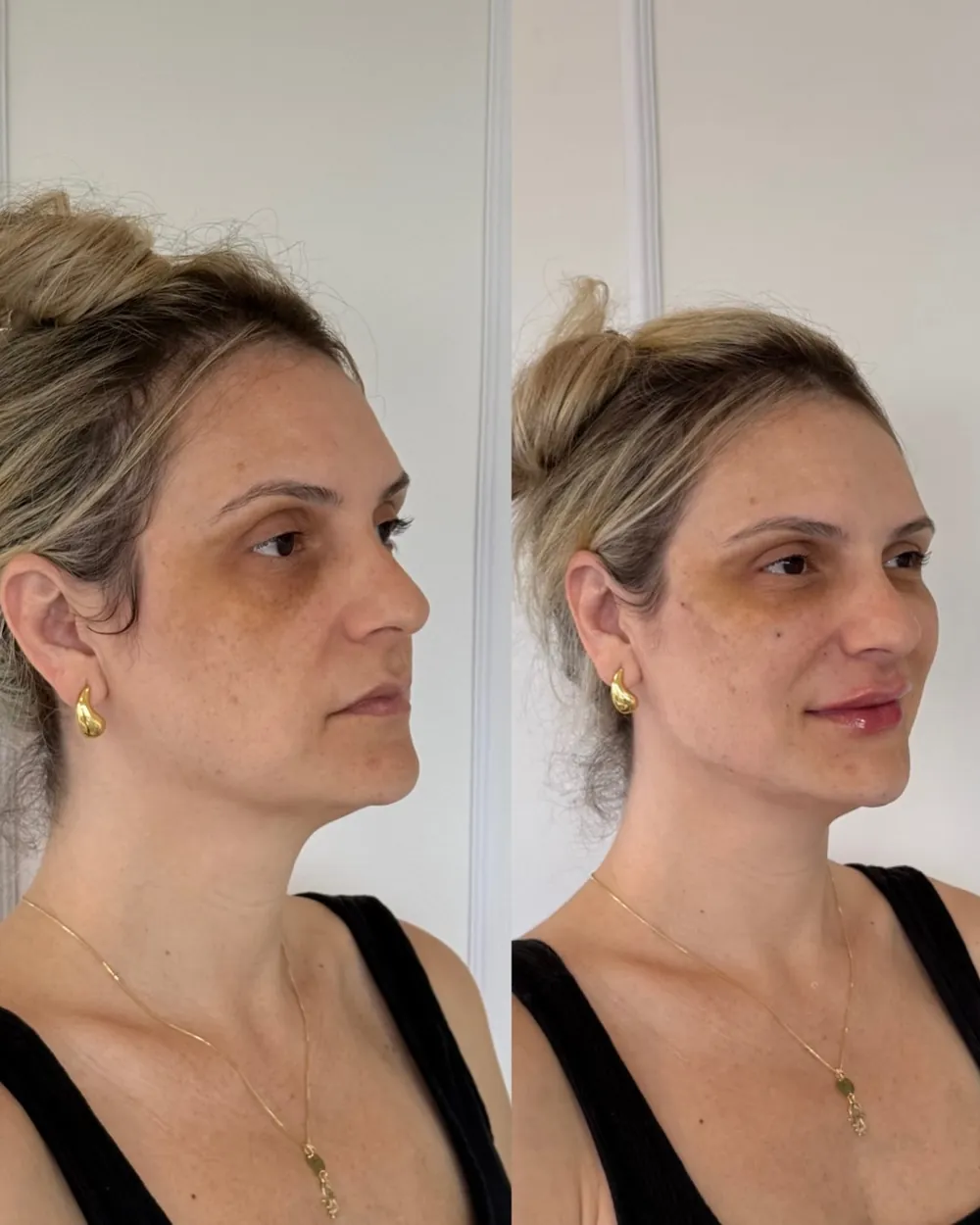 Caso 02: antes e depois, ângulo três quartos
