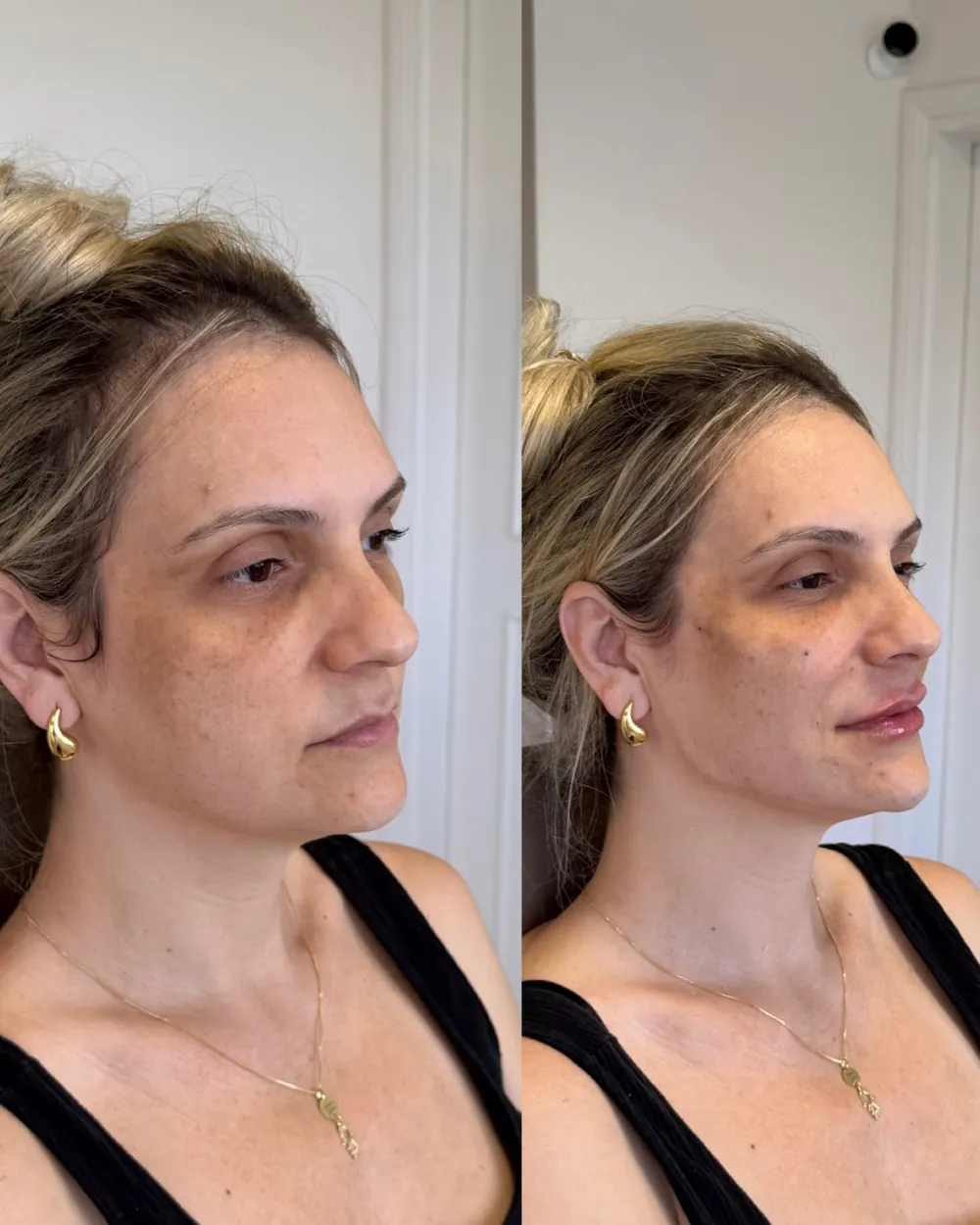 Caso 02: antes e depois, terceiro ângulo