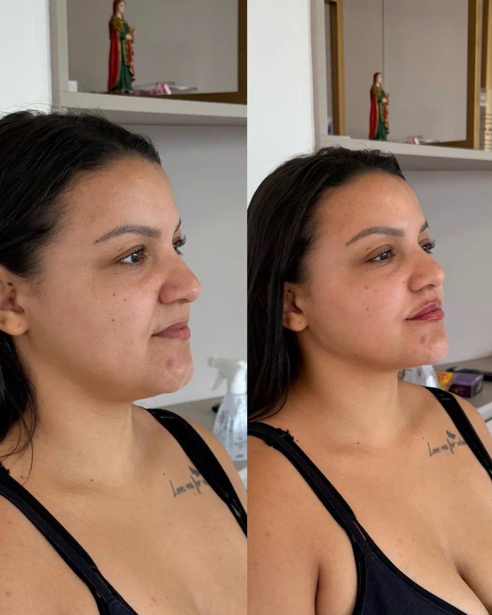 Caso 03: antes e depois de harmonização orofacial, perfil