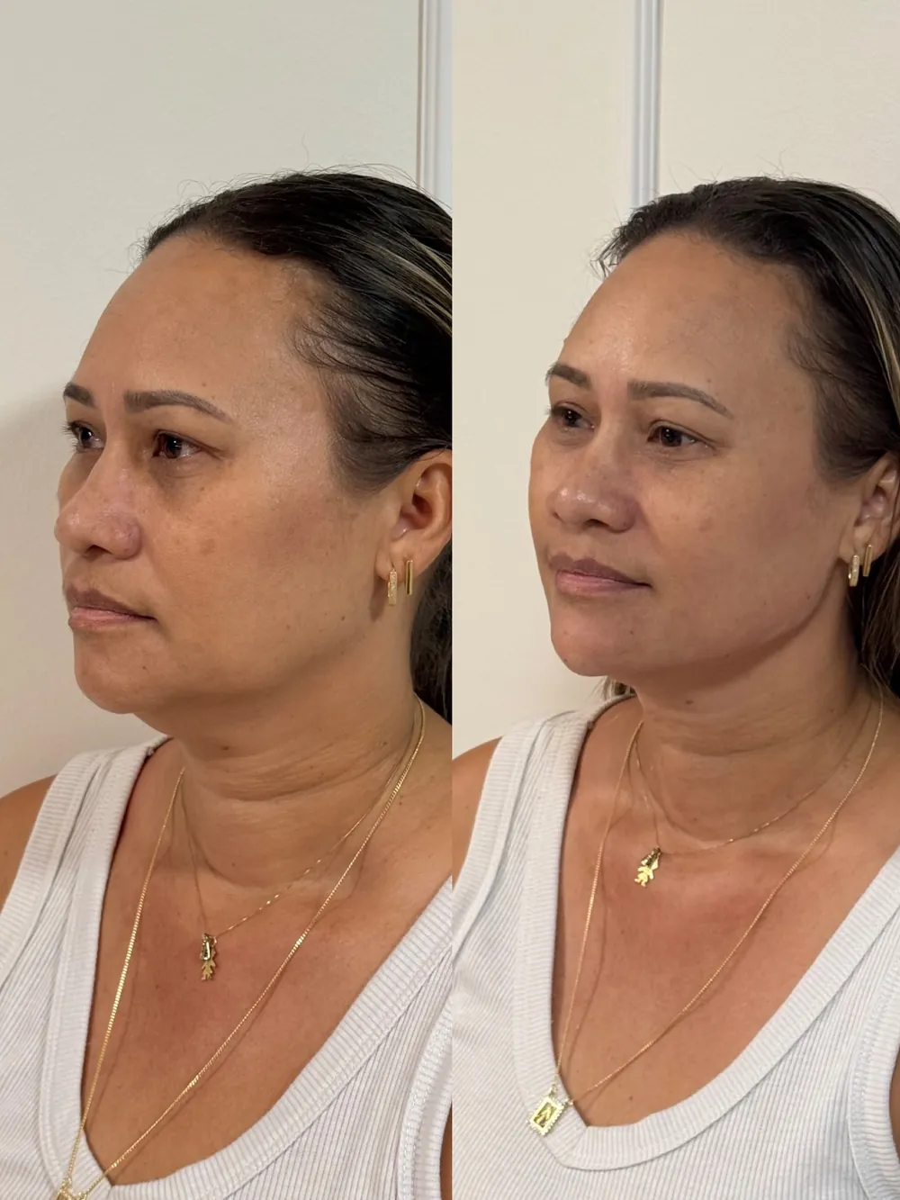 Caso 04: antes e depois de harmonização orofacial, mandíbula e pescoço