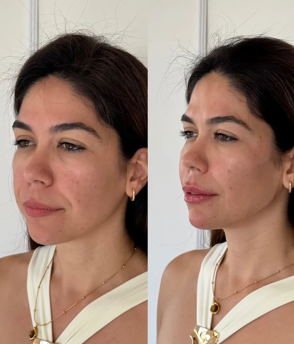 Caso 06: antes e depois de harmonização orofacial, terço inferior