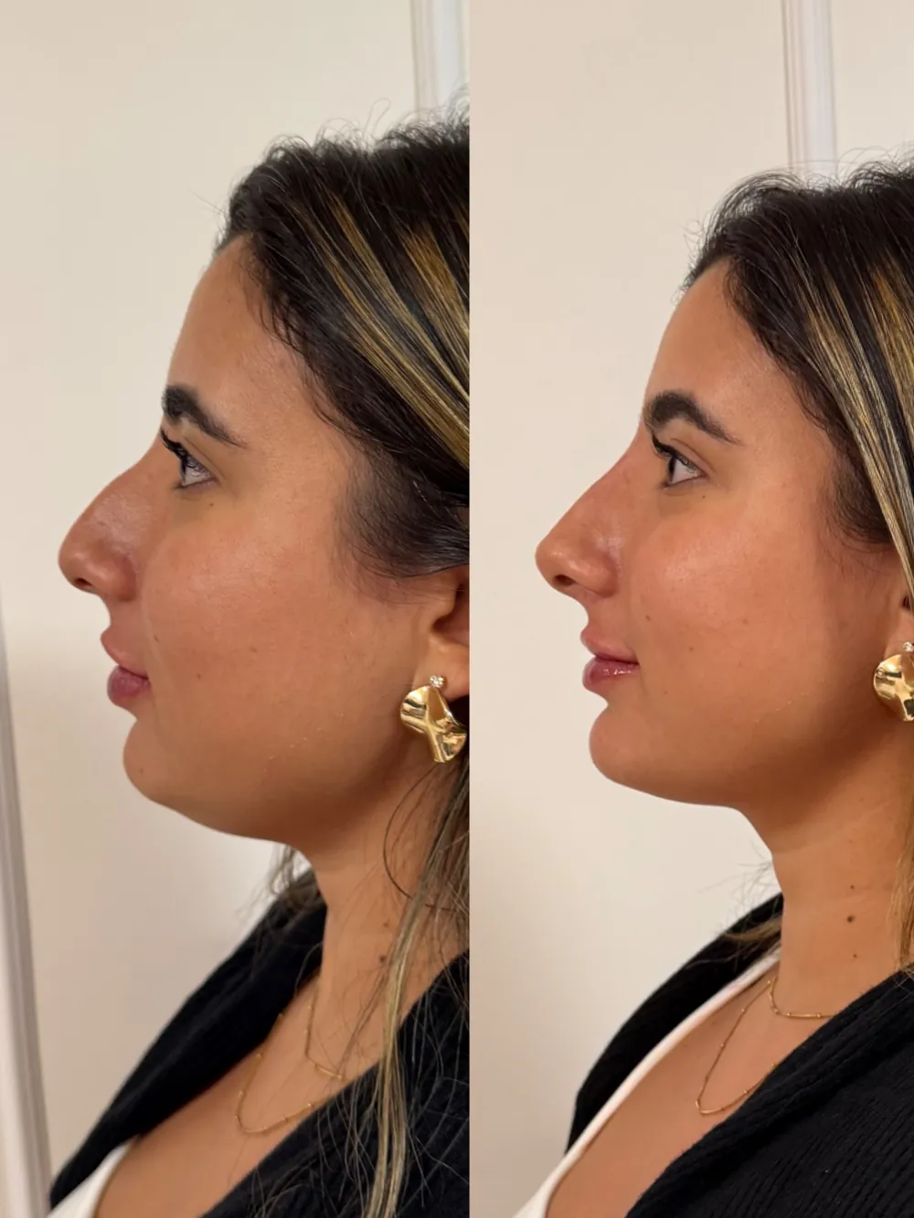 Caso 07: antes e depois de harmonização orofacial, perfil