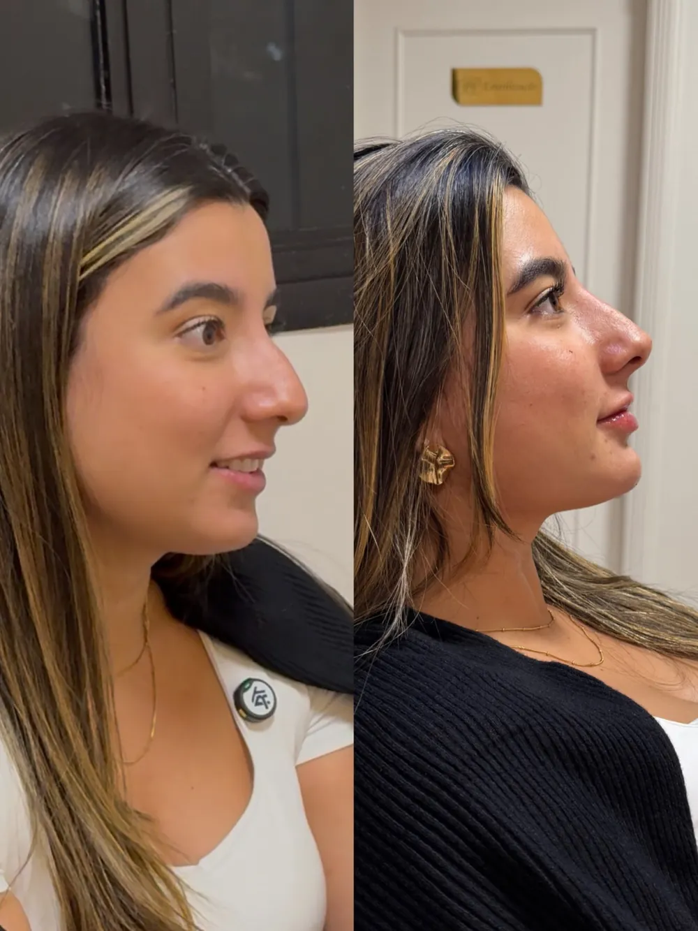 Caso 07: antes e depois, quarto ângulo