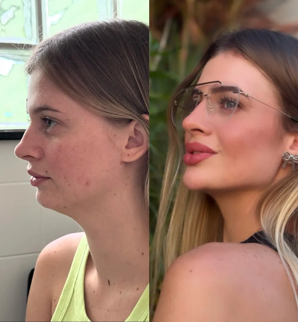 Caso 08: antes e depois de harmonização orofacial, perfil