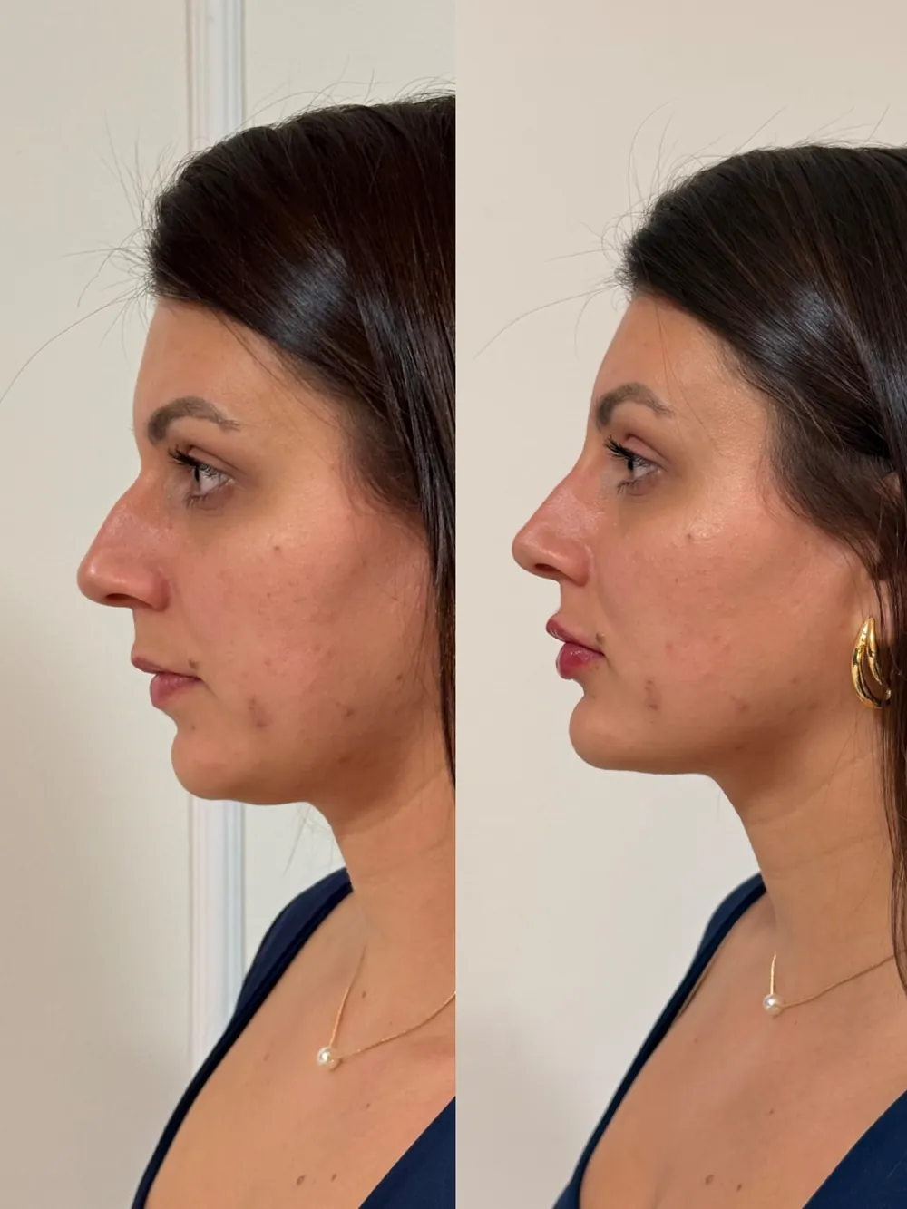 Caso 09: antes e depois de harmonização orofacial, perfil