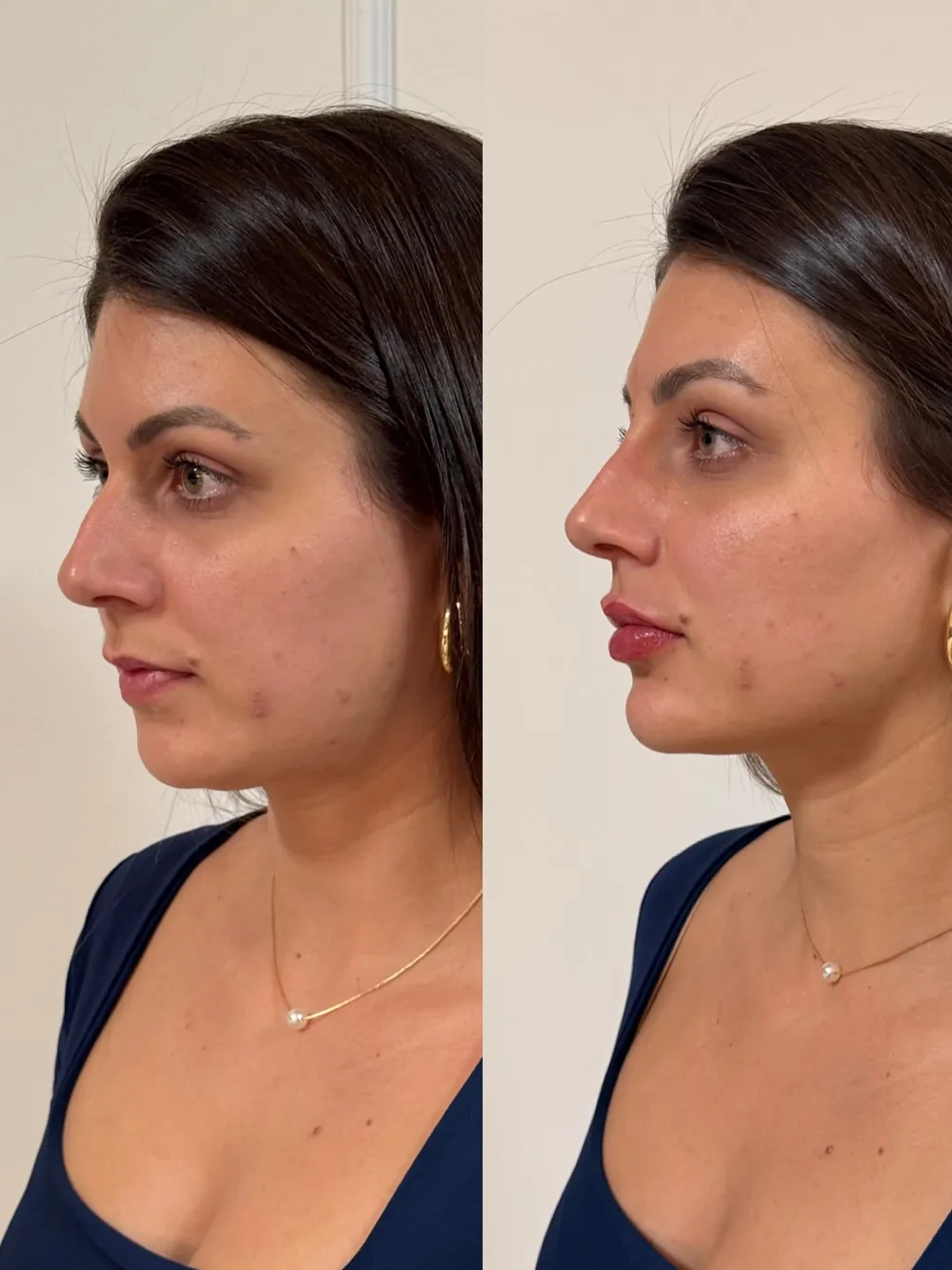 Caso 09: antes e depois, quarto ângulo