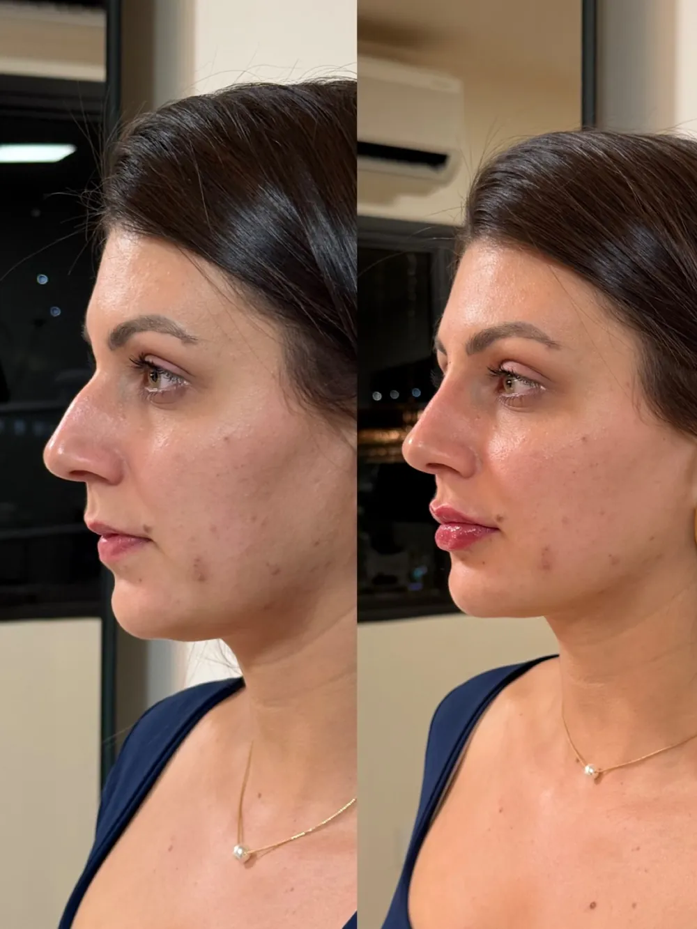 Caso 09: antes e depois, quinto ângulo