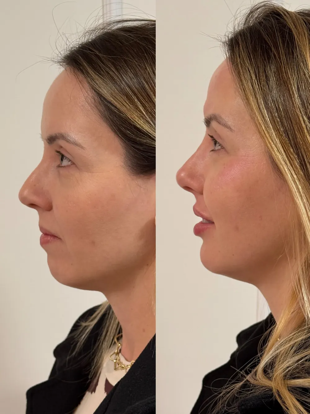 Caso 10: antes e depois de harmonização orofacial, perfil