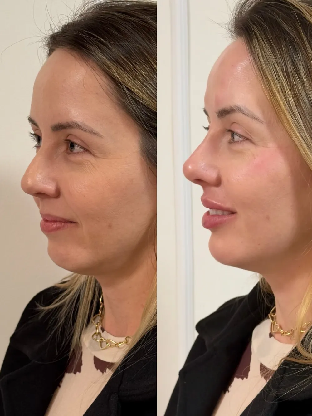 Caso 10: antes e depois, terceiro ângulo