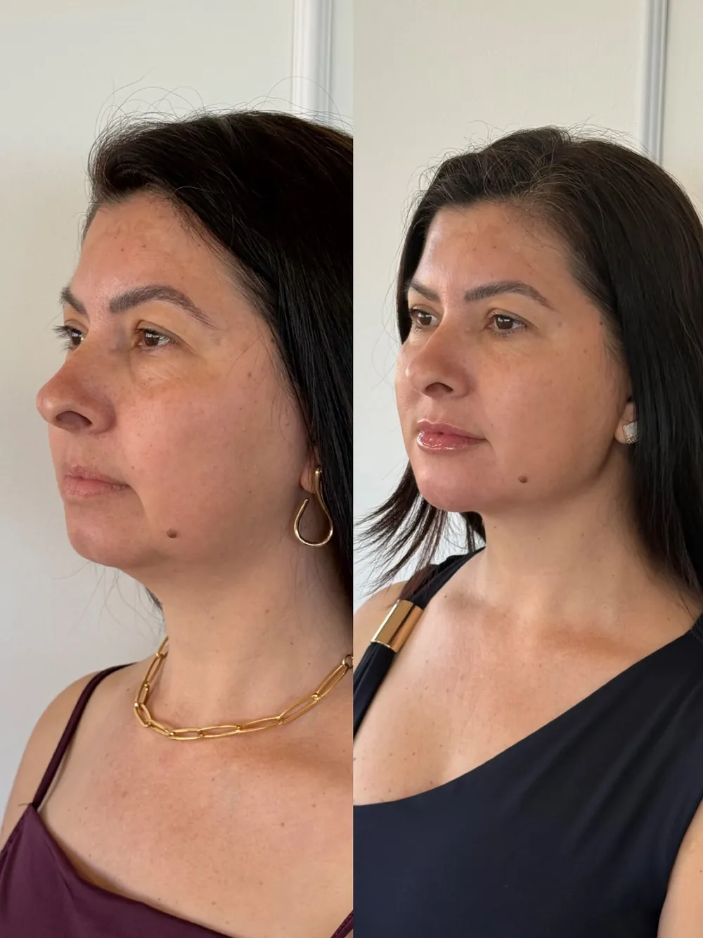 Caso 11: antes e depois de harmonização orofacial, contorno de mandíbula