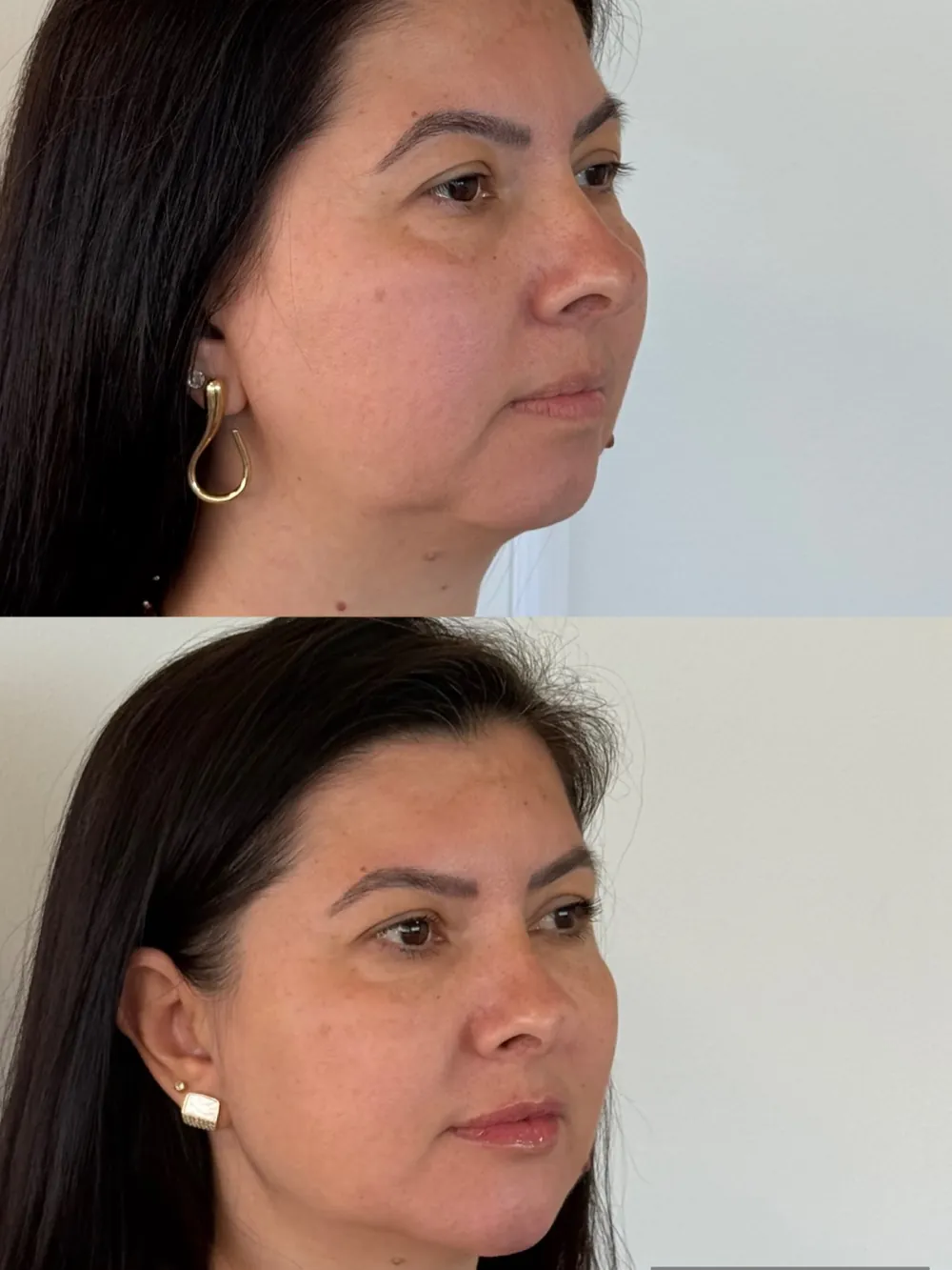 Caso 11: antes e depois, segundo ângulo