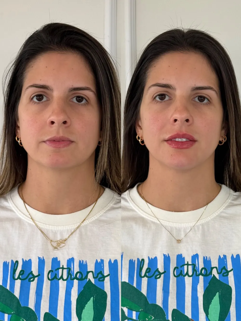Caso 12: antes e depois de harmonização orofacial, perfil