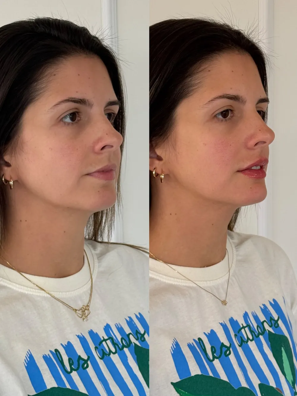 Caso 12: antes e depois, terceiro ângulo