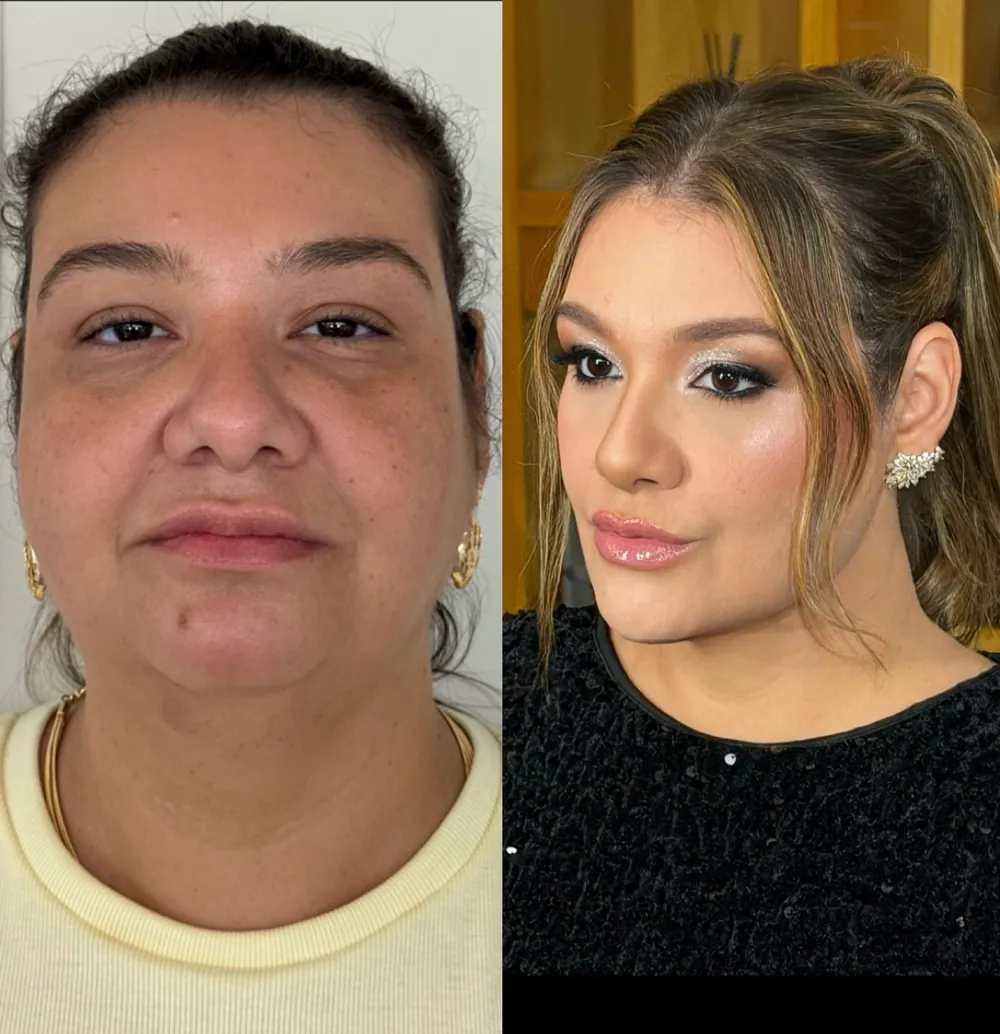 Caso 13: antes e depois de harmonização orofacial