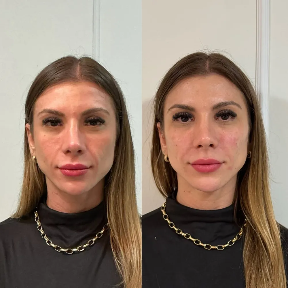 Caso 14: antes e depois de harmonização orofacial