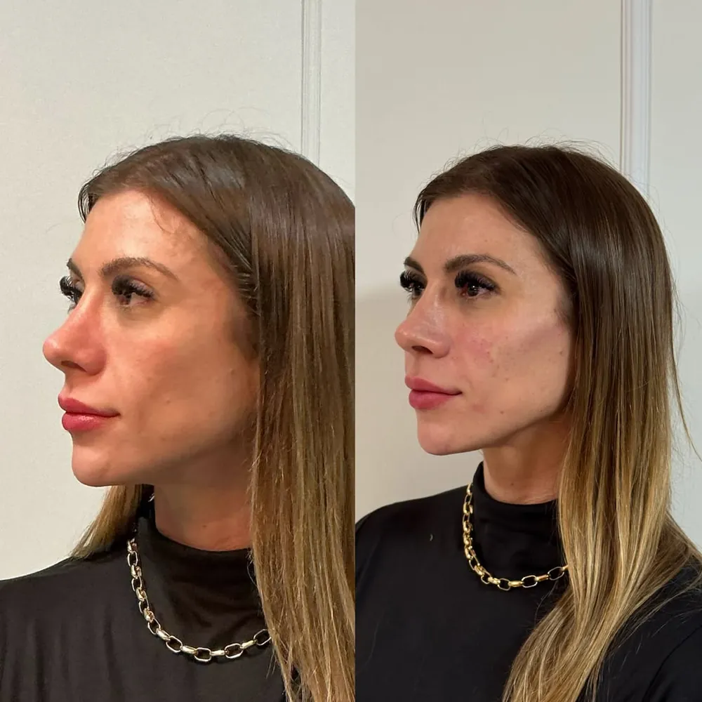 Caso 14: antes e depois, segundo ângulo